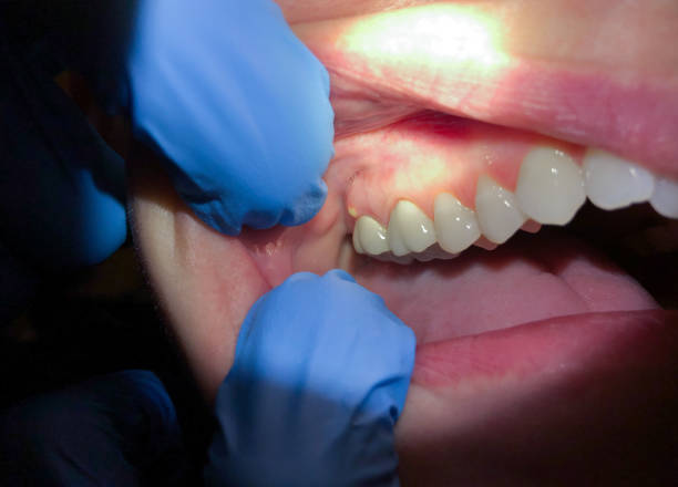 Best Emergency Dental Extractions in Hyattsville, MD